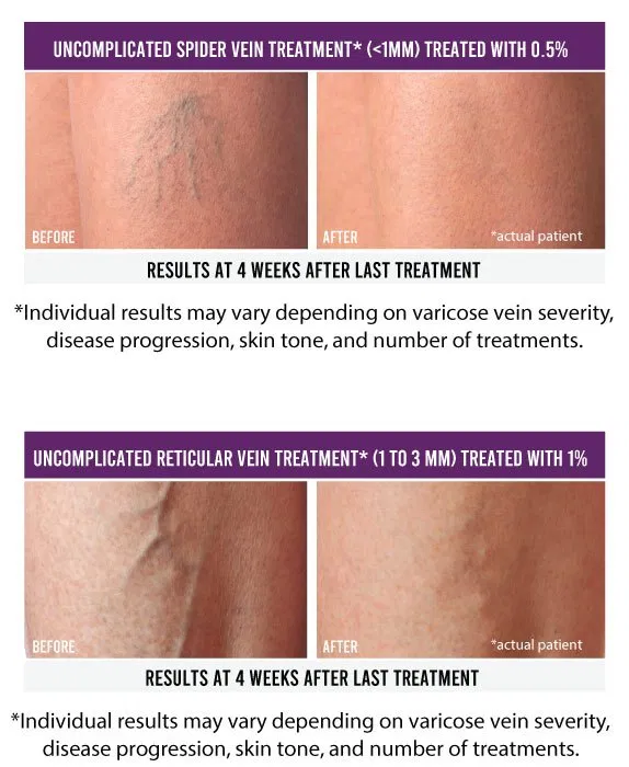 Sclerotherapy: What is it, who’s it for, and should I get it?