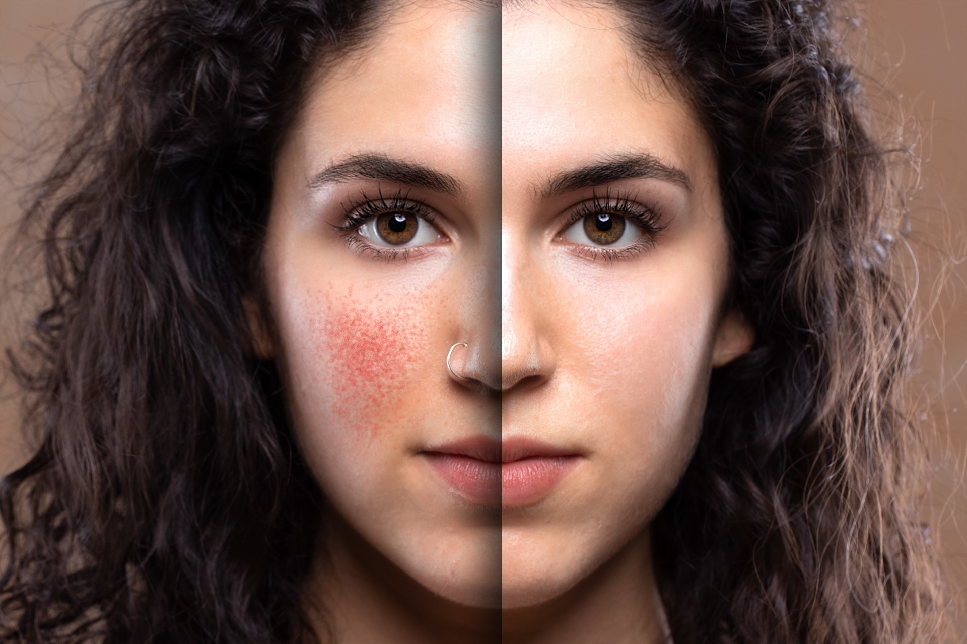 Rosacea—The Good, the Bad, and the Red