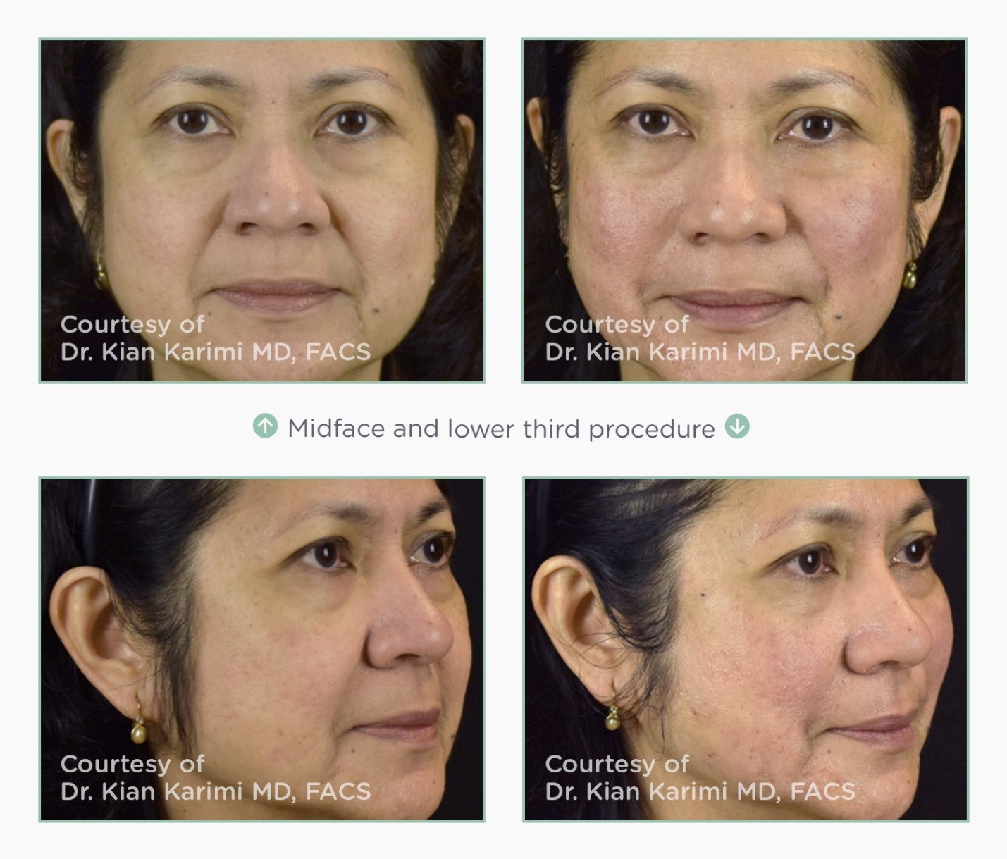 HA+ Firming Boost — The Botox Lady