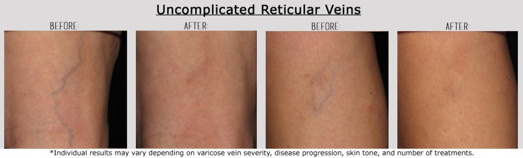 Are you a Candidate for Varicose Vein Surgery? - Miami Vein Center