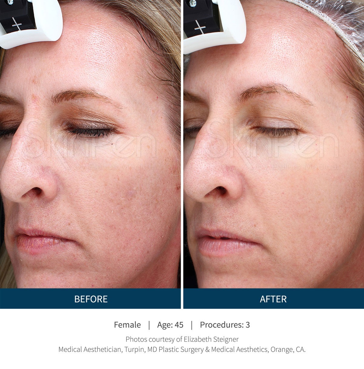 Microneedling… The Collagen Booster