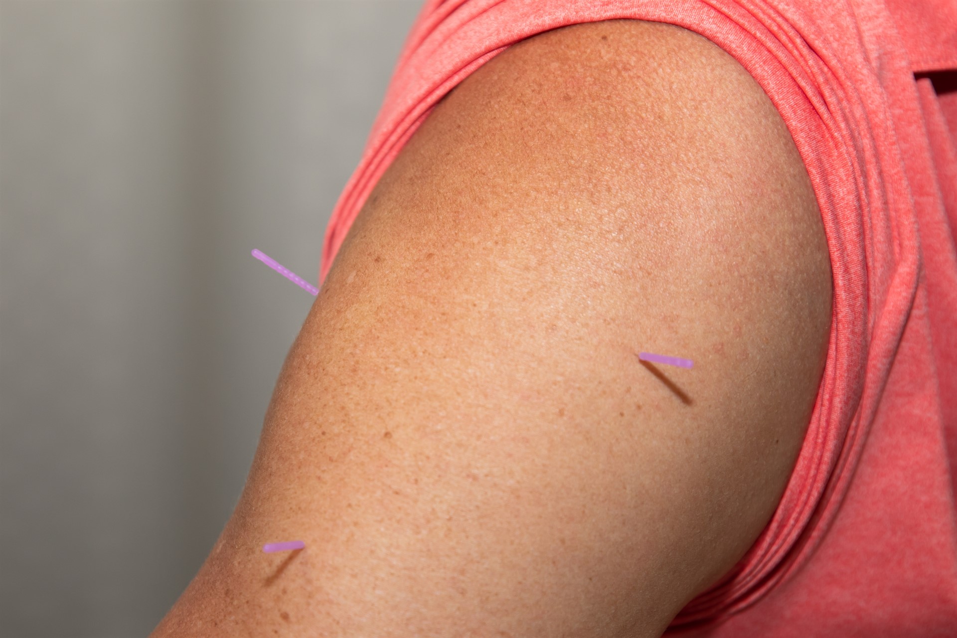 Rehabilitation Department offers Dry Needling